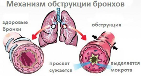 Обструктивний бронхіт у дітей до року, 2-3 років – причини, ознаки, симптоми і лікування бронхіту у дітей