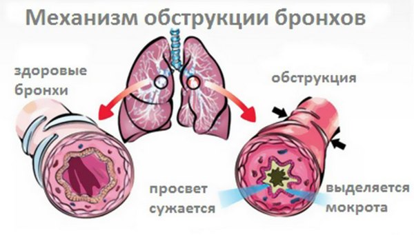 Обструктивний бронхіт у дітей симптоми і лікування Обструктивний бронхіт у дітей симптоми і лікування