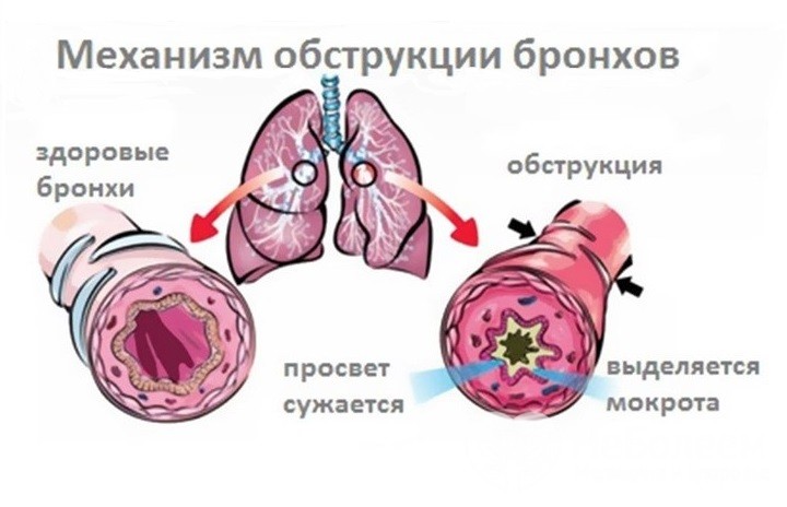 Обструктивний бронхіт у дітей симптоми і лікування