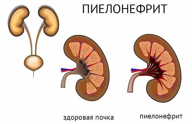 Обструктивний пієлонефрит що це таке