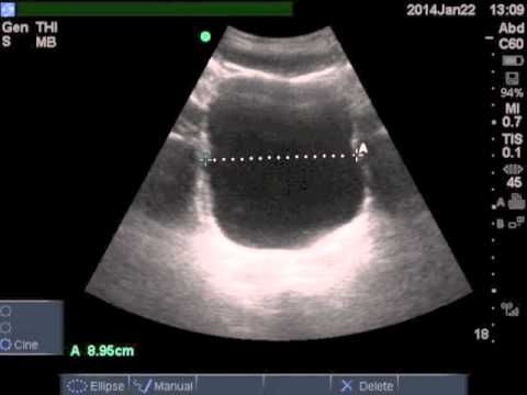 Обсяг залишкової сечі в сечовому міхурі норма і відхилення