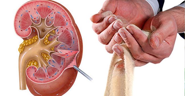 Очищення нирок у домашніх умовах — 7 простих способів Очищення нирок у домашніх умовах — 7 простих способів