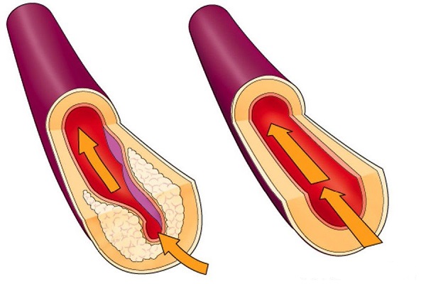 Очистити судини від холестеринових бляшок і тромбів