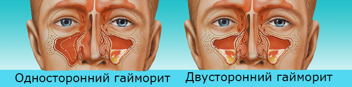Односторонній гайморит правосторонній і лівосторонній симптоми і лікування