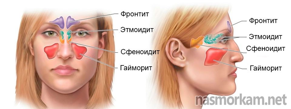 Односторонній гайморит правосторонній і лівосторонній симптоми і лікування