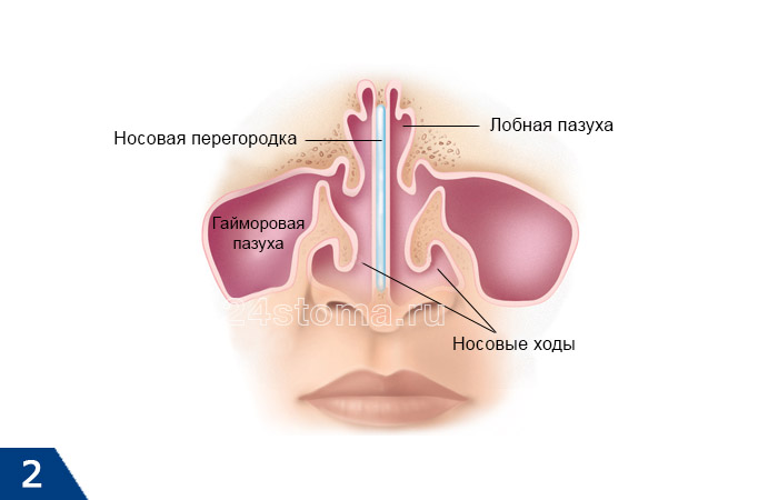 Одонтогенний гайморит лікування народними засобами Одонтогенний гайморит лікування народними засобами