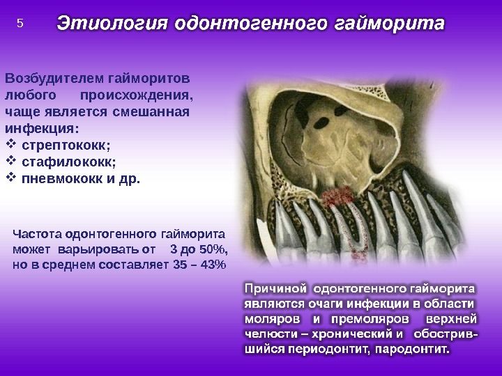 Одонтогенний гайморит лікування народними засобами Одонтогенний гайморит лікування народними засобами