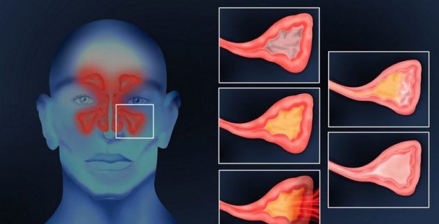 Одонтогенний гайморит – опис, симптоми і лікування