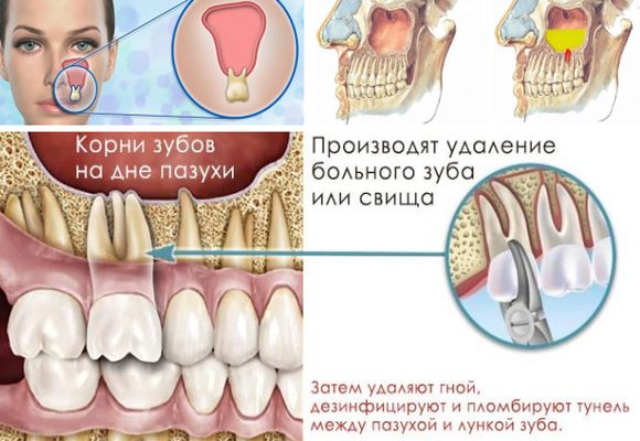Одонтогенний гайморит і верхньощелепної синусит від хворого зуба – причини і симптоми 2019 Одонтогенний гайморит і верхньощелепної синусит від хворого зуба – причини і симптоми 2019