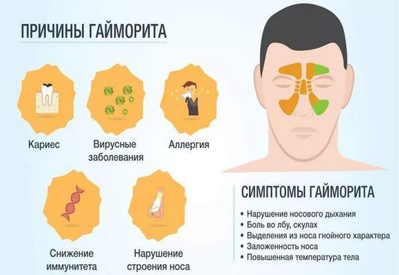 Огляд кращих сучасних лікарських препаратів у різних формах від гаймориту