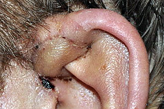 Околоушный свищ: причини, симптоми та особливості лікування Околоушный свищ: причини, симптоми та особливості лікування