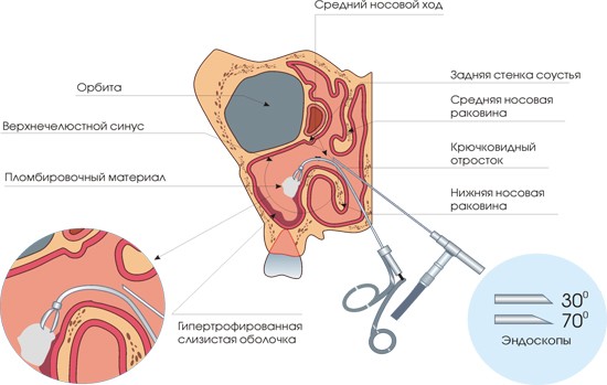 Операції при гаймориті: діагностика гаймориту на знімку, прокол, ендоскопія