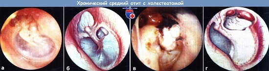 Операція на вусі при хронічному гнійному отиті