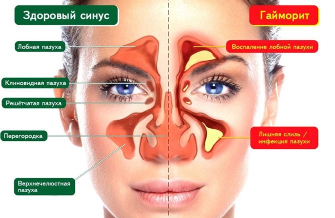Операція при гаймориті: як роблять чистку пазух носа?