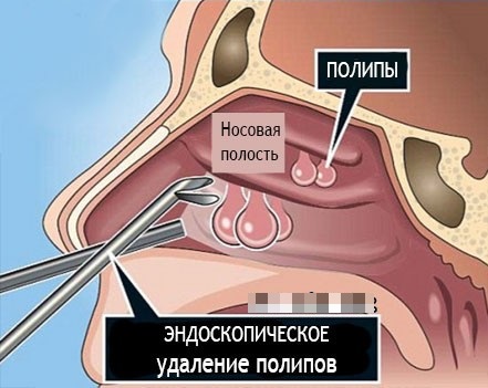 Операція з видалення поліпів у носі шейвером, лазером, радіохвильовим методом. Як робиться, застосування наркозу, наслідки