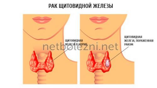Осип голос причини у дорослого. Осипло горло: причини і методи лікування
