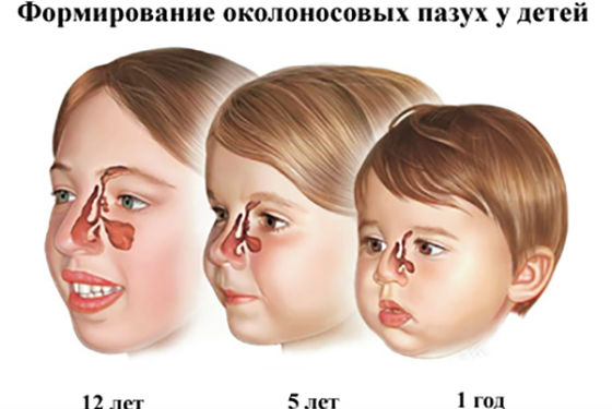 Основні різновиди та ознаки гаймориту у дітей 12-річного віку