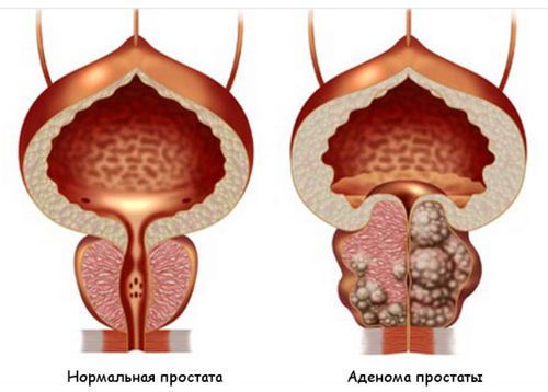 Основні симптоми хвороб сечового міхура у чоловіків