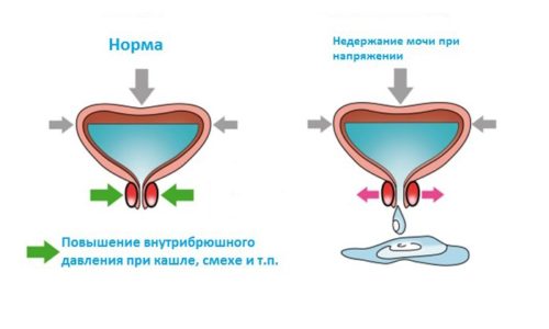 Основні симптоми хвороб сечового міхура у чоловіків