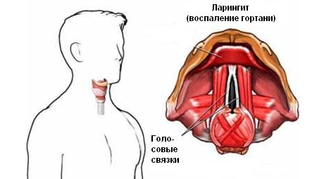 Основні симптоми ларингіту і фарингіту