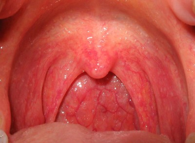 Основні симптоми ларингіту і фарингіту