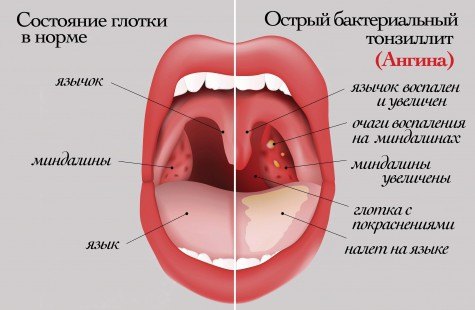 Основні симптоми та правила лікування ангіни у дітей Основні симптоми та правила лікування ангіни у дітей