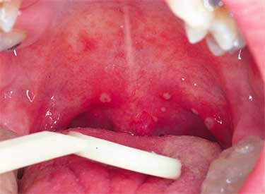 Особливості герпесной ангіни у дітей і дорослих: причини, симптоми і способи лікування. Причини, симптоми і лікування герпесной ангіни у дітей і дорослих