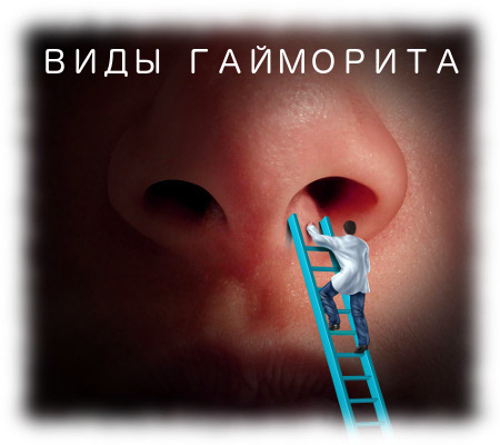 Особливості грибкового гаймориту і 3 ефективного методу лікування Особливості грибкового гаймориту і 3 ефективного методу лікування