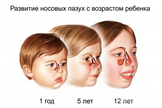 Особливості лікування гаймориту у дітей
