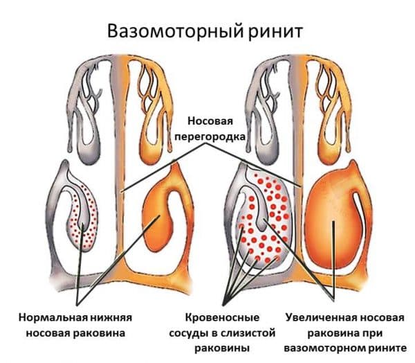Особливості лікування хронічного вазомоторного риніту