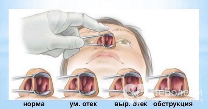 Особливості лікування хронічного вазомоторного риніту