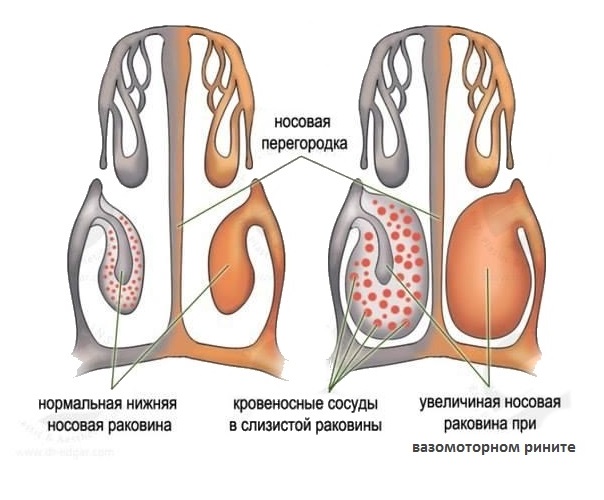 Особливості лікування хронічного вазомоторного риніту