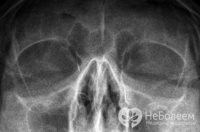 Особливості лікування хронічного вазомоторного риніту