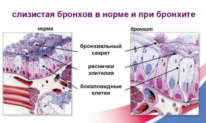 Особливості лікування обструктивного бронхіту у дітей