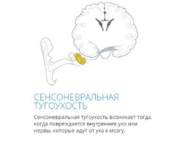 Особливості лікування сенсоневральної приглухуватості