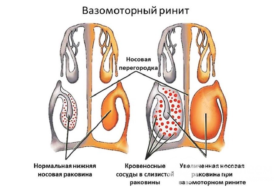 Особливості лікування вазомоторного риніту