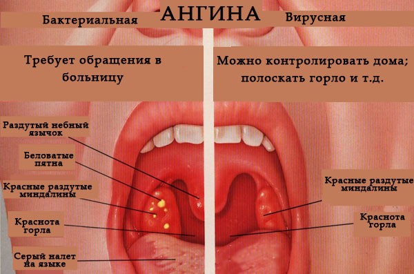 Особливості лікування запалення мигдалини з одного боку