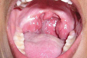 Особливості лікування запалення мигдалини з одного боку
