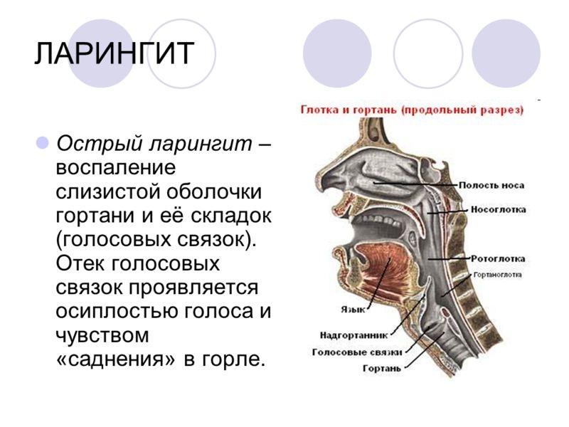 Особливості розвитку ларингіту і як правильно лікувати його у дорослих. Чим лікують ларингіт? Ларингіт: лікування антибіотиками. Чим лікувати ларингіт у дорослого