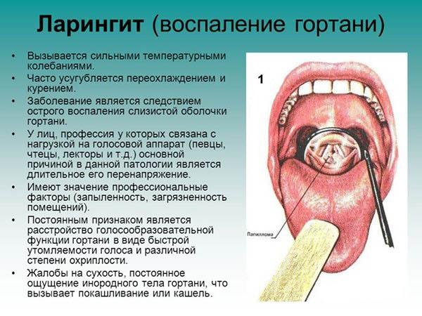 Особливості розвитку ларингіту і як правильно лікувати його у дорослих. Чим лікують ларингіт? Ларингіт: лікування антибіотиками. Чим лікувати ларингіт у дорослого