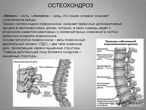 Остеохондроз поперекового відділу лікування народними засобами