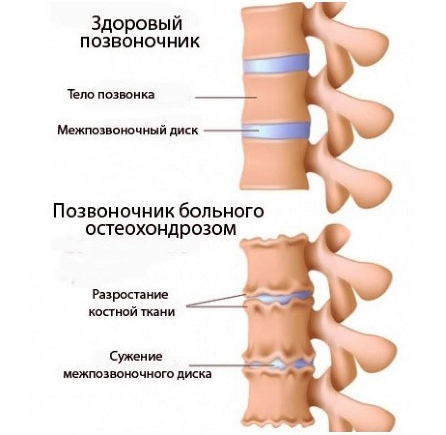 Остеохондроз шийного відділу хребта лікування народними засобами