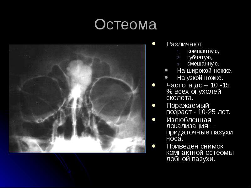 Остеома лобової пазухи – що це таке, симптоми і лікування
