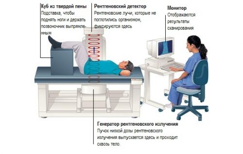 Остеопенія лікування препарати. Лікування остеопенії народними засобами