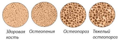 Остеопенія лікування препарати. Лікування остеопенії народними засобами