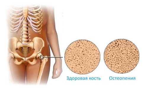 Остеопенія лікування препарати. Лікування остеопенії народними засобами