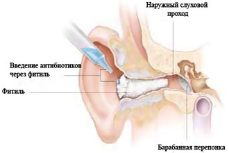Отит лікування в домашніх умовах Отит лікування в домашніх умовах