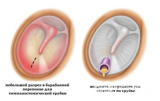 Отит – причини, симптоми, що робити, як лікувати отит? Наслідки та профілактика Отит – причини, симптоми, що робити, як лікувати отит? Наслідки та профілактика