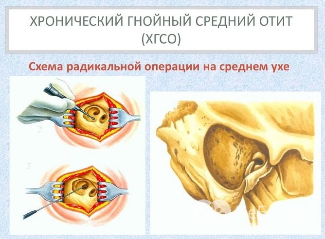 Отит – причини, симптоми, що робити, як лікувати отит? Наслідки та профілактика Отит – причини, симптоми, що робити, як лікувати отит? Наслідки та профілактика