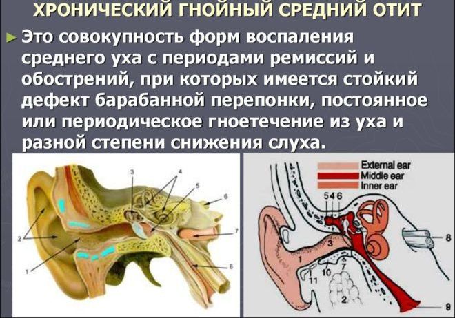 Отит середнього вуха його симптоми і лікування Отит середнього вуха його симптоми і лікування